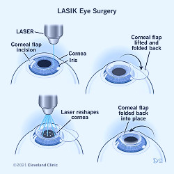 LASIK Eye Surgery